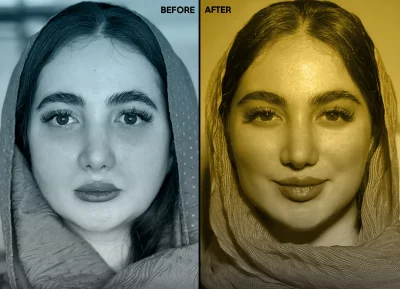 تزریق فیلر به گونه برای افزایش حجم و فرمدهی صورت زنانه